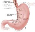 Gastroparesis: Causes
