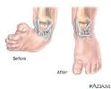 Clubfoot deformity: MedlinePlus Medical Encyclopedia Image