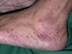 <b>Vasculitis</b>