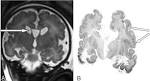 of <b>Zellweger Syndrome</b>