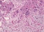 File:HE aspergillus multinucleated giant cells.jpg - Wikimedia Commons