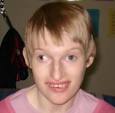 Angelman Syndrome Photos