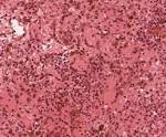 <b>lymphoid tissue</b>. Answer