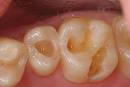 Birth of a New Earth: HOW TO HEAL A CAVITY NATURALLY WITHOUT ...