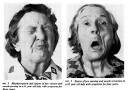 DYSTONIA Blepharospasm and