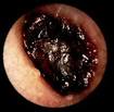 Ear Wax