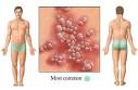 <b>male genital</b> herpes