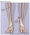 Types of Bone Fractures: Buckle Fracture, Stress Fracture ...