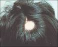 Alopecia in Women - March 1, 2003 - American Family Physician