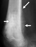 Bone Tumors and Tumorlike Conditions: Analysis with Conventional ...