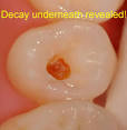 Cavities | Palm Beach County, Boynton Beach, West Palm Beach, Boca ...