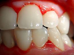 gingivitis-signos-y-sintomas