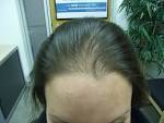 FEMALE HAIR LOSS: RESULTS WITHIN 4 MONTHS | The Hair Centre, Hair ...