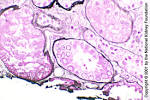 of <b>BK virus</b> associated