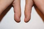 File:Clubbed thumb 2.JPG - Wikipedia, the free encyclopedia