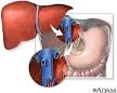 Liver Transplantation: MedlinePlus