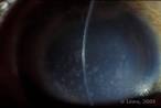 Corneal Stromal Dystrophies. EyeRounds.