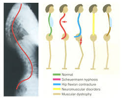 improving posture