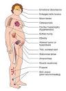 Cushing's Syndrome | Nursing Crib
