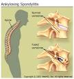 Ankylosing Spondylitis: Pain, Symptoms, Treatments, Causes, and More