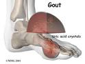 Gout diet | gout treatment | gout symptoms | what is gout caused by