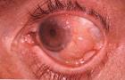 <b>Carcinoma</b>, <b>Conjunctival</b>