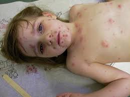 babies diseases