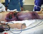 File:Gas <b>gangrene</b>.jpg