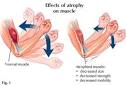 <b>Atrophy</b> Definition