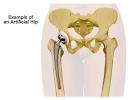 Hip Replacement Surgery - Thomas Jefferson University Hospitals