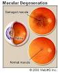 of macular degeneration is