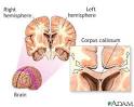 <b>Corpus callosum</b> of the brain