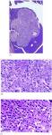 <b>Islet cell adenoma</b> in one EAT www.sciencedirect.com