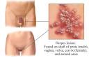 Genital herpes