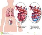 Pneumonia Stock Image - Image: 23933611