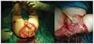 por presencia <b>de gangrena</b>