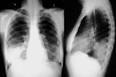 A <b>pneumonia</b> se caracteriza