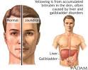 Jaundice is a condition