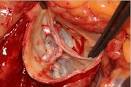 Bicuspid <b>Aortic Valve</b>
