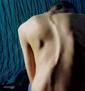 <b>Scoliosis</b>-04
