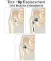 Arthroplasty Care | Nursing Crib