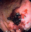 Upper <b>gastrointestinal bleeding</b> - Wikipedia, the free encyclopedia