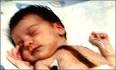 Baby Fae: Lived for 20 days