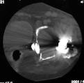 <b>OSTEOLYSIS</b> Radiograph and CT