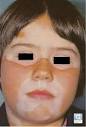 Vitiligo    Globale Dermatologie