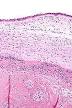 <b>Chorioamnionitis</b> - Wikipedia, the free encyclopedia
