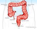Colitis Types, Causes, Symptoms, Diagnosis, and Treatment on ...