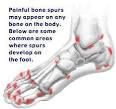 Avoid Bone Spur Surgery - Natural Bonespurs Help
