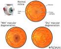 Macular degeneration is a