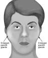 <b>Sjögren's syndrome</b> is